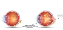 Göz Tansiyonu Nedir? Tedavisi Nasıl Gerçekleştirilir?