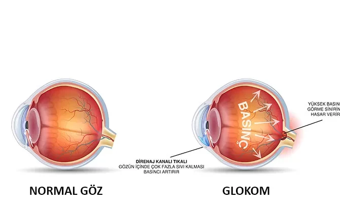 Göz Tansiyonu Nedir? Tedavisi Nasıl Gerçekleştirilir?