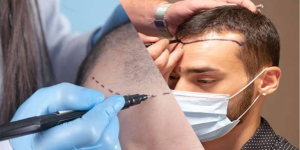 Türkiye saç ekiminde dünya lideri oldu